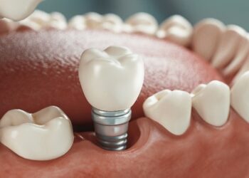 implante dental