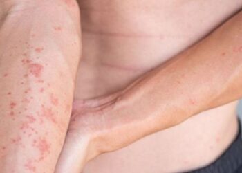 Dermatitis atópica
