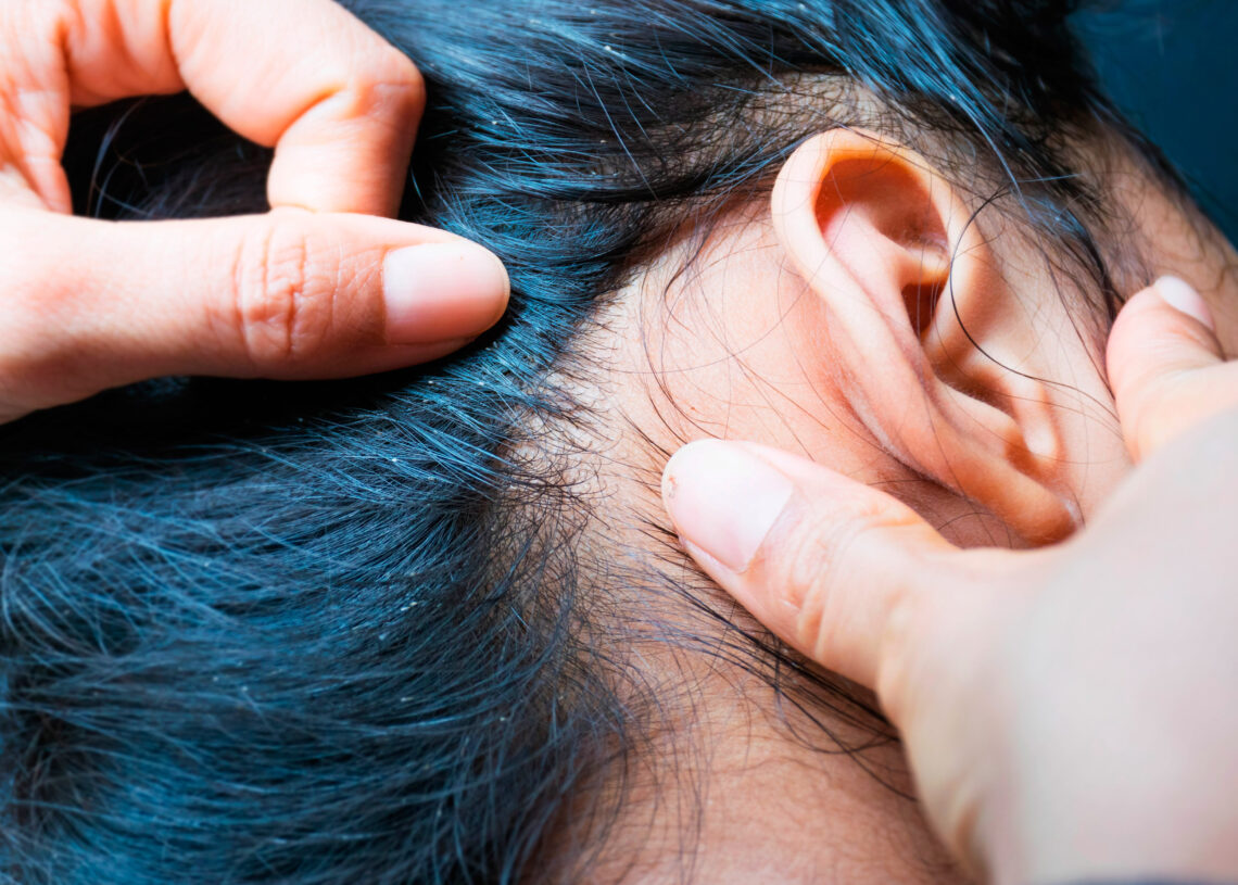 cabello con piojos