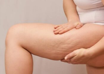 pierna con celulitis