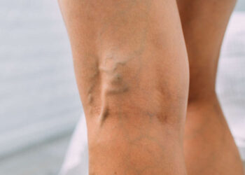 Esclerosis de varices, la técnica para lograr unas piernas perfectas