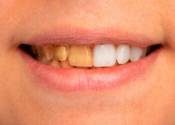 Diferencias entre tratamientos dentales profesionales y no profesionales